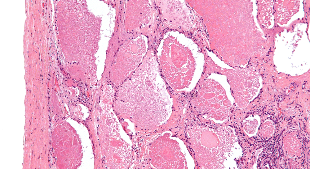Pljučnaalveolarnaproteinoza.jpg